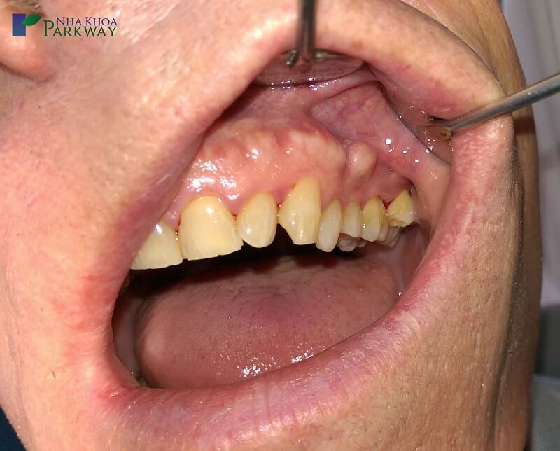 Chân Răng Bị Nhô Ra: Nguyên Nhân, Triệu Chứng và Cách Điều Trị