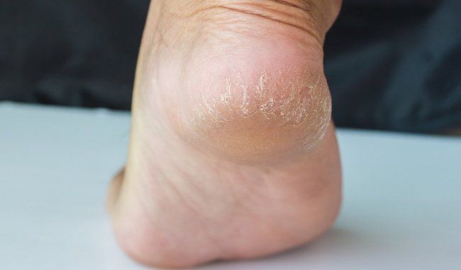 Chân tay nứt nẻ là thiếu chất gì?