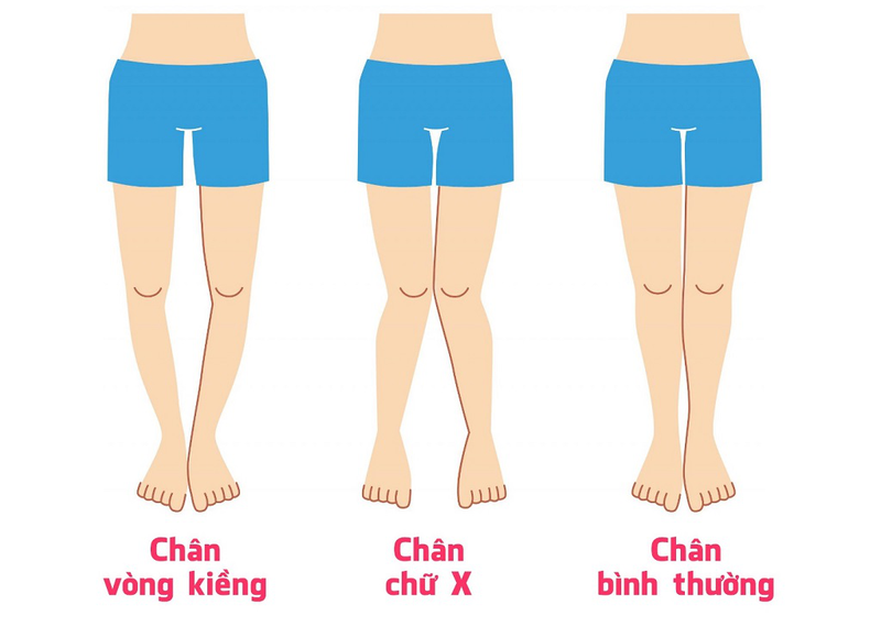Chân thẳng là như thế nào?