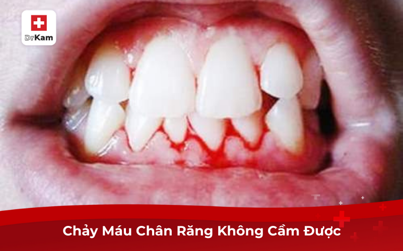 Chảy máu chân răng không cầm được: Nguyên nhân và cách xử trí