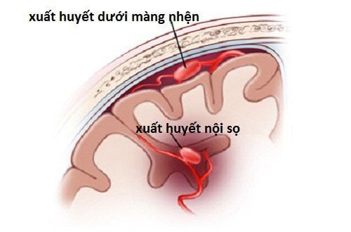 Chảy máu dưới nhện
