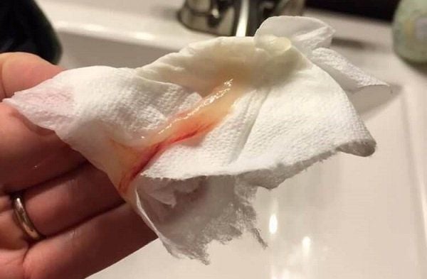 Chảy Máu Hồng Nhạt: Nguyên Nhân và Cách Xử Trí