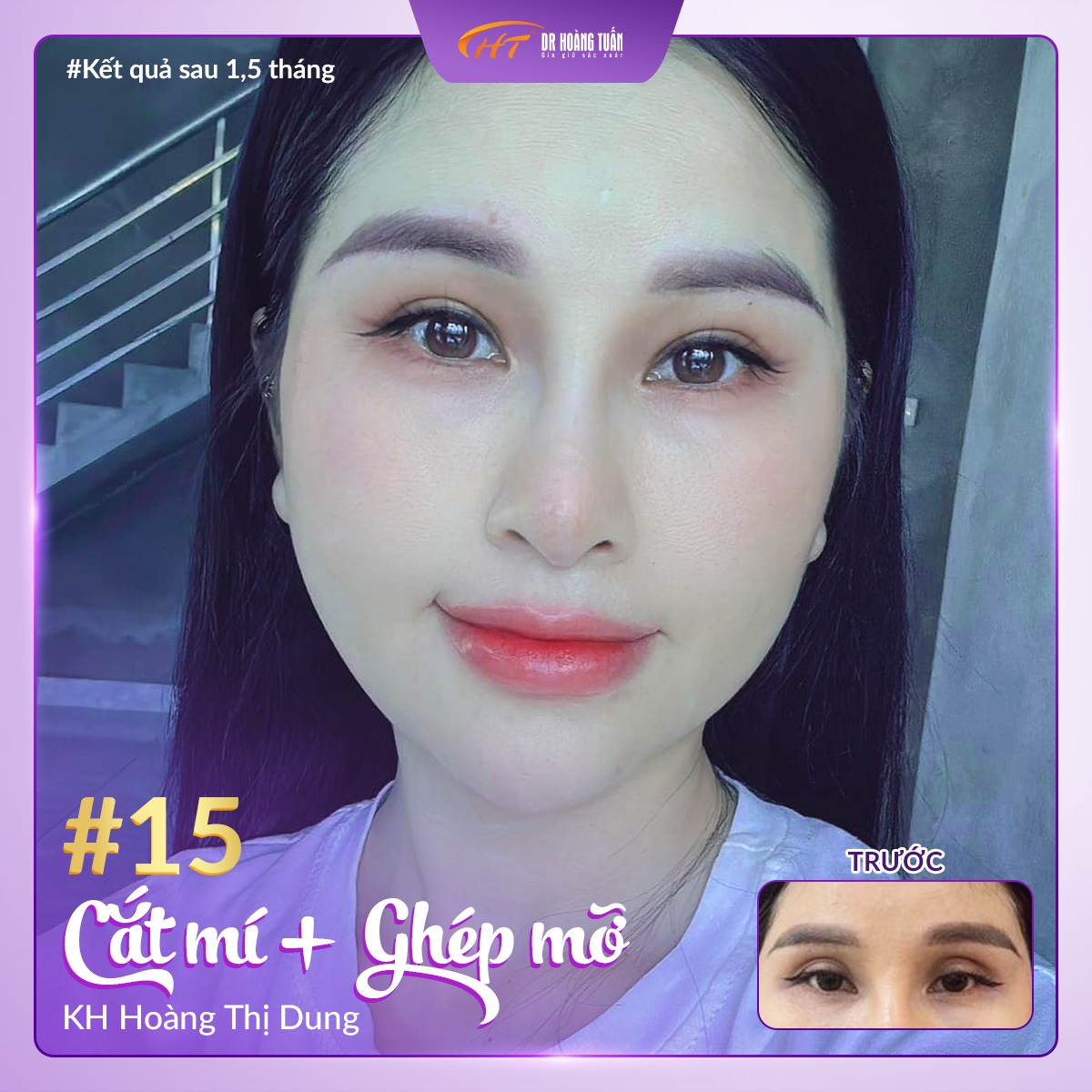 Cách Làm Đầy Hốc Mắt Tự Nhiên Gallery 1