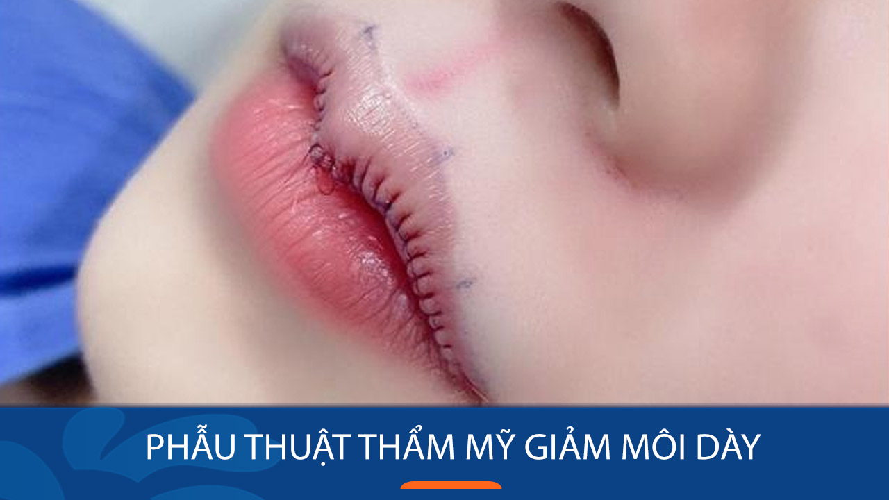 Cắt môi dày thành mỏng Gallery 2