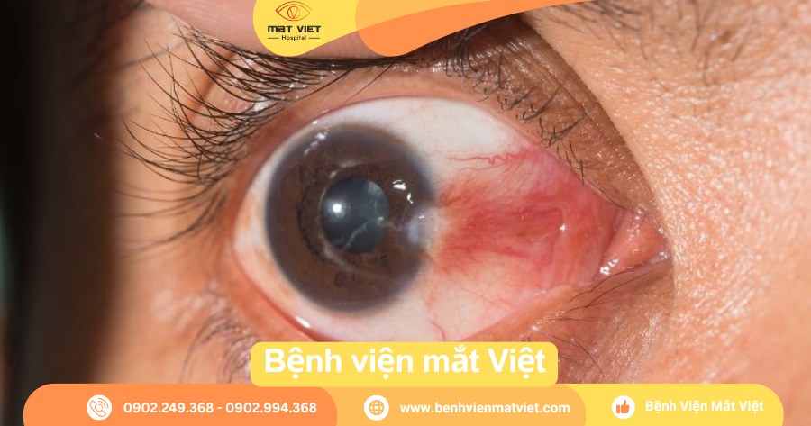 Lột Mộng Mắt Hết Bao Nhiêu Tiền? Gallery 2
