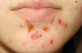 Chốc Chốc Là Gì?