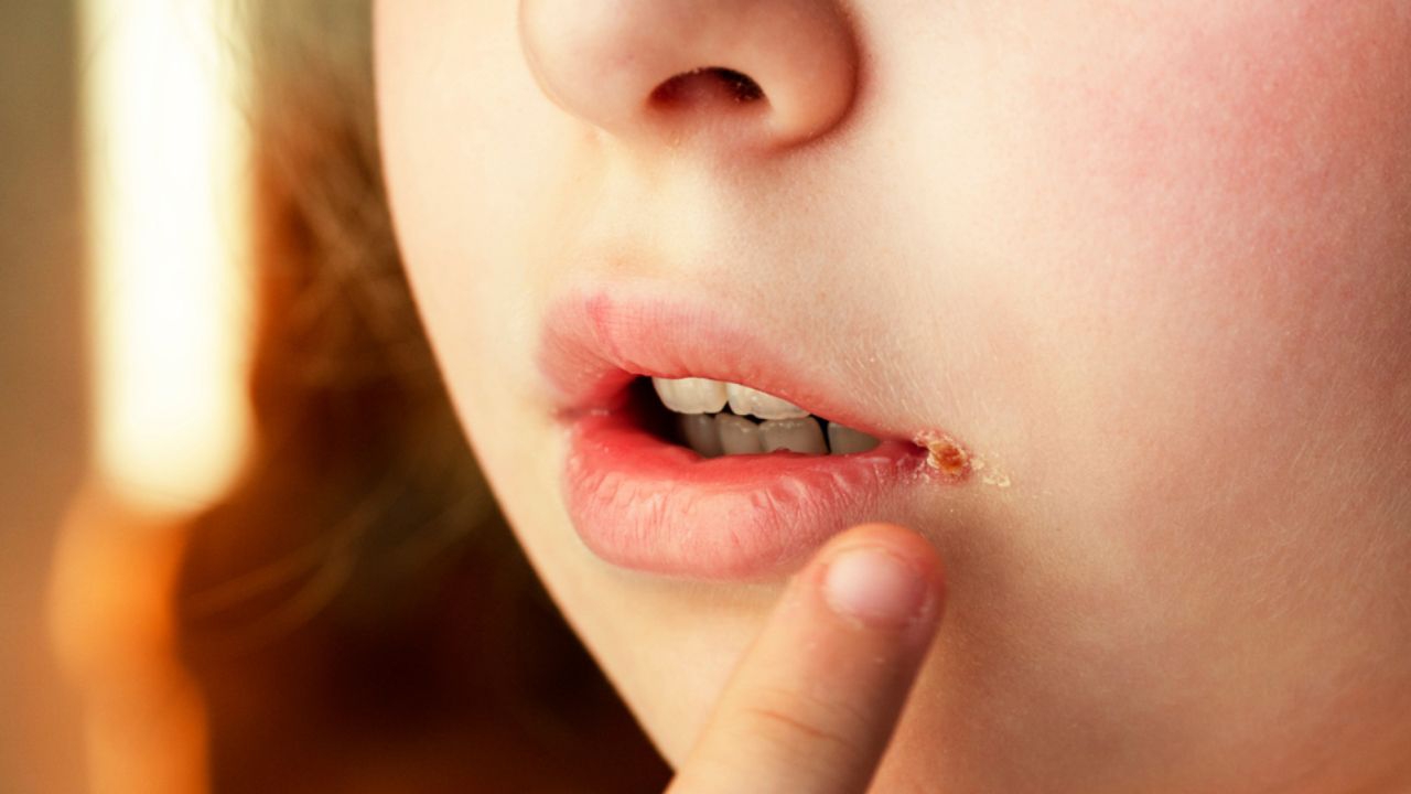 Chốc Mép Ở Trẻ: Nguyên Nhân, Triệu Chứng Và Cách Điều Trị