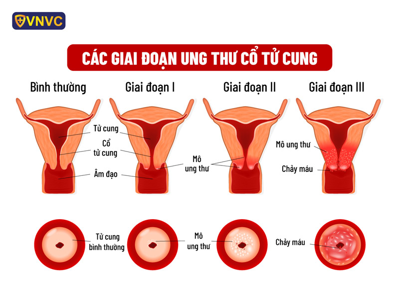 Cách Điều Trị CIN 3 Gallery 2