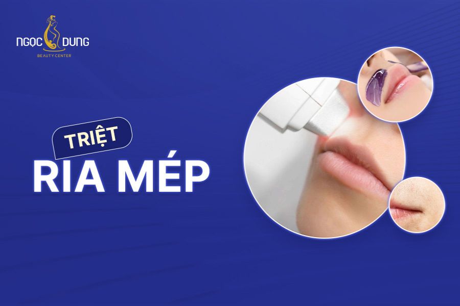 Cách Trị Ria Mép Hiệu Quả và An Toàn Gallery 2