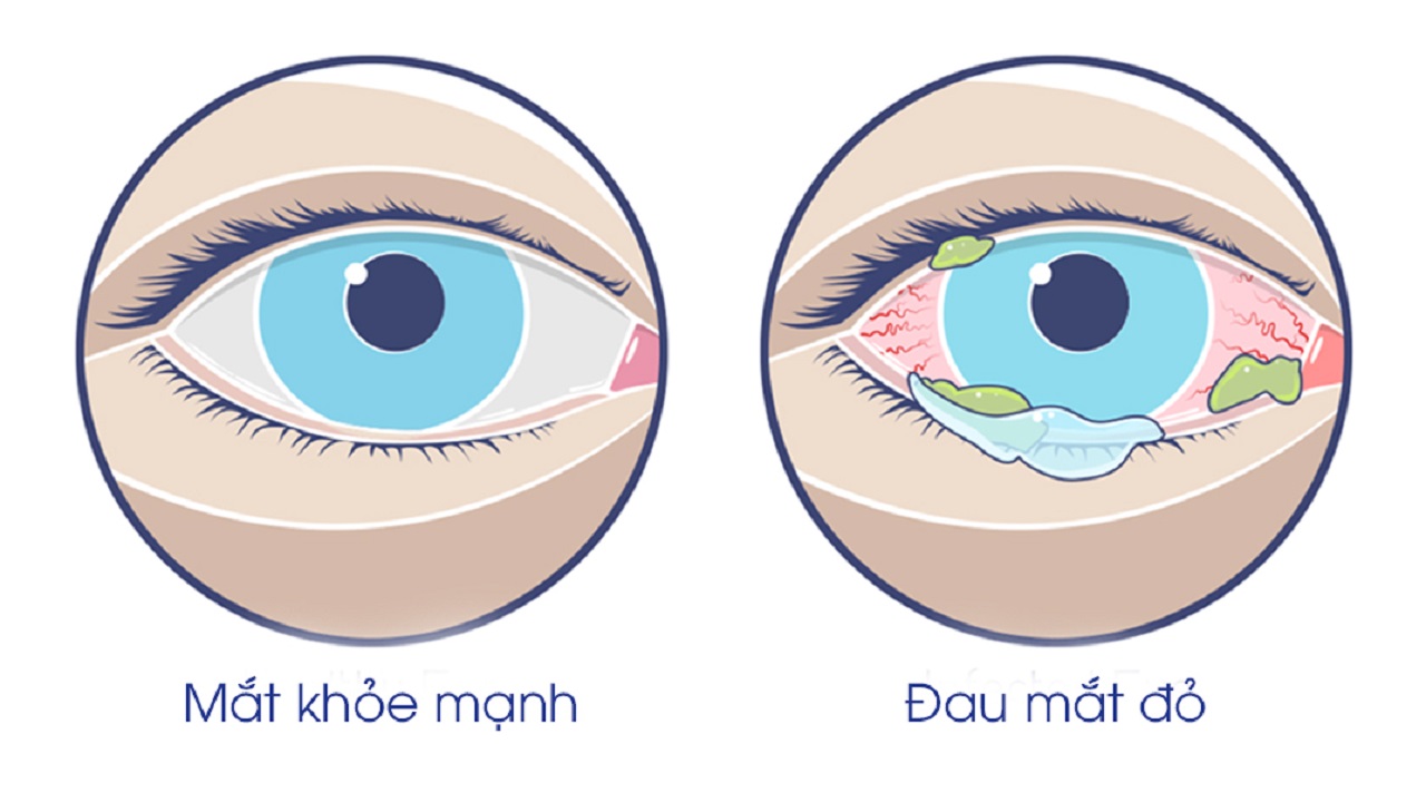 Chữa Đau Mắt Đỏ Bằng Lá Trầu Không