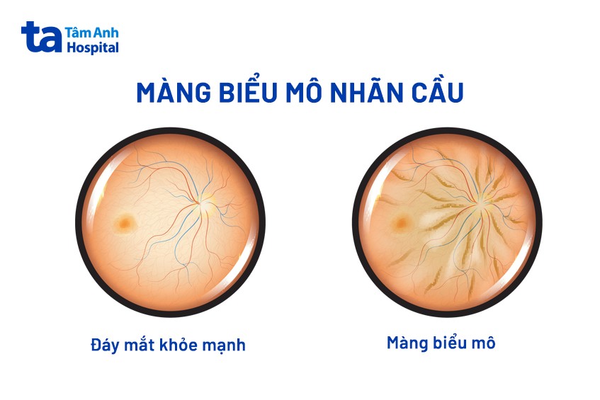 Màng Trước Võng Mạc Gallery 2