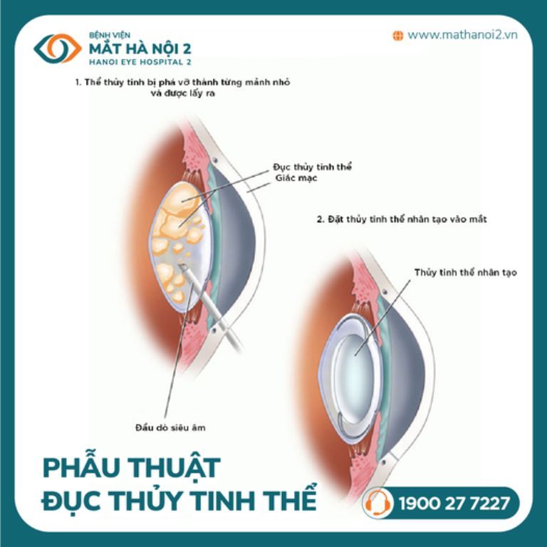 Thủy tinh thể là gì? Gallery 2