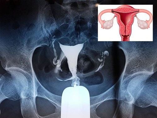 Chụp HSG có đau không?