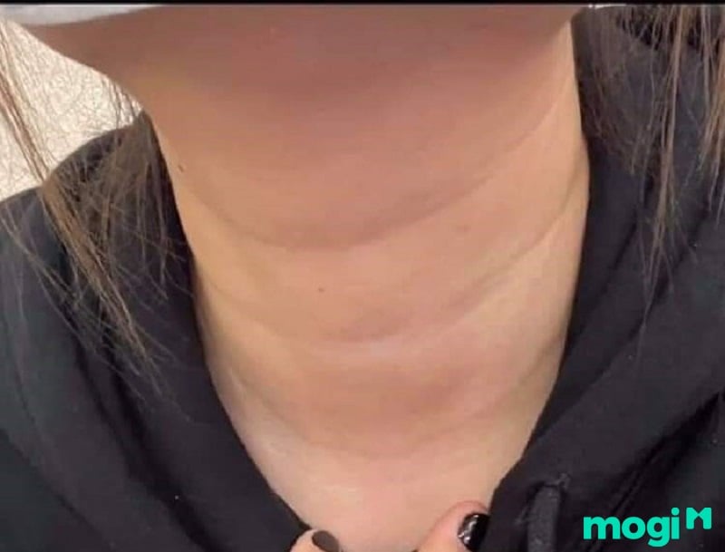 Cổ 3 Ngấn Nói Lên Điều Gì?