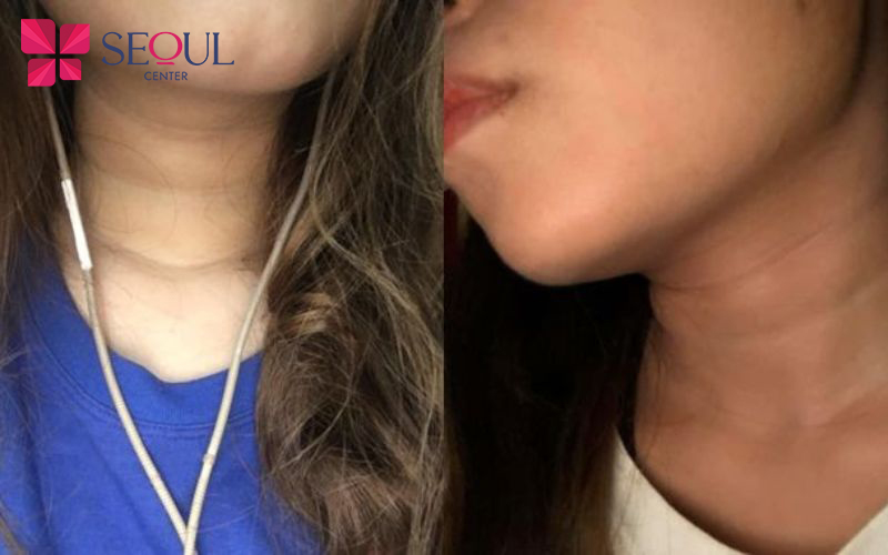 Cổ 3 Ngấn Nói Lên Điều Gì? Gallery 2