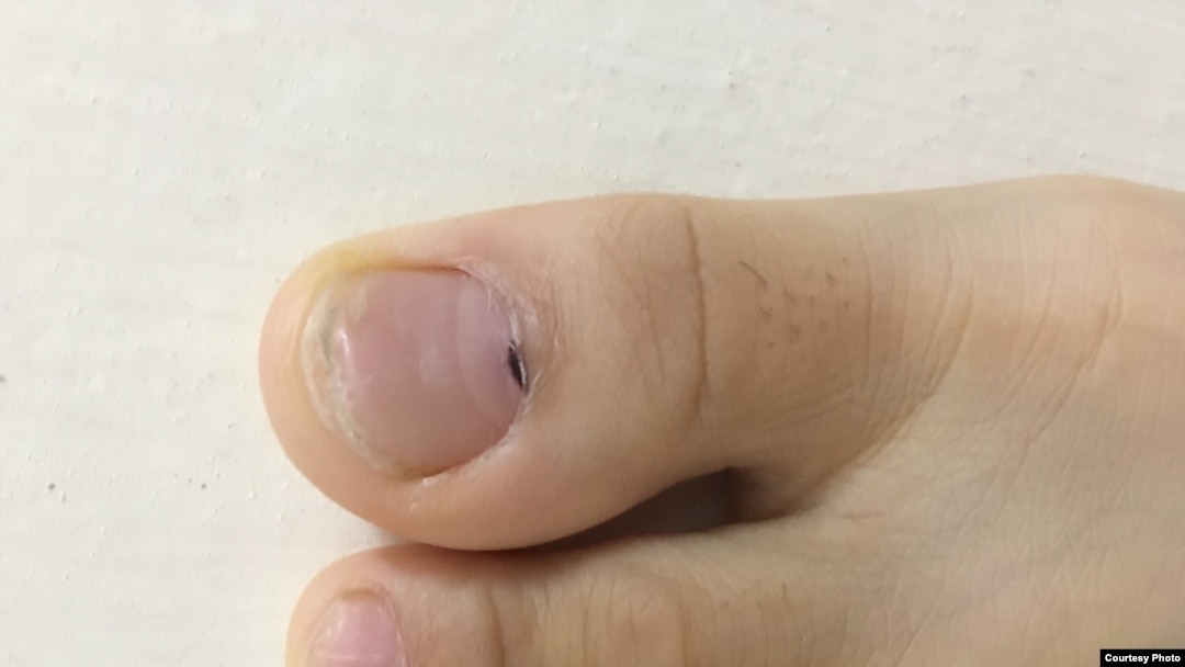 Chấm đen trong móng chân: Nguyên nhân và cách xử lý