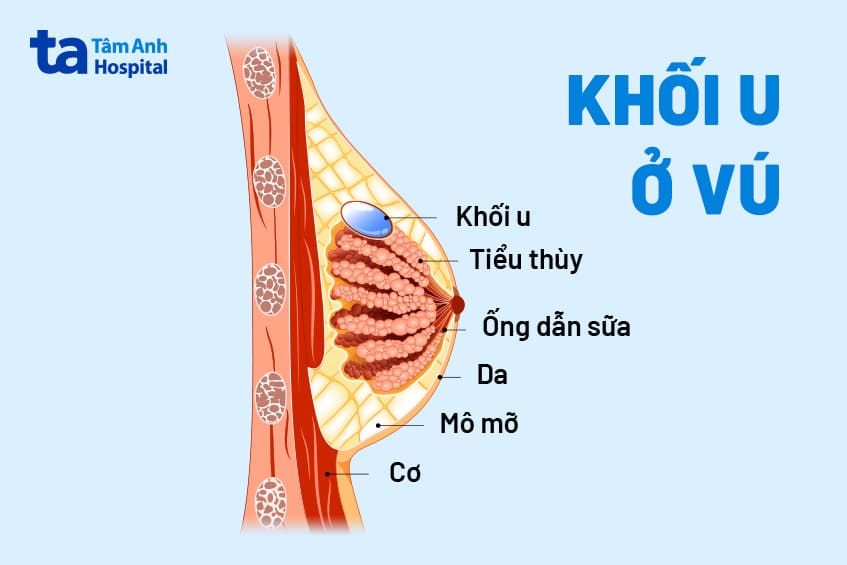 Có cục cứng ở vú