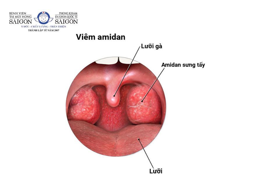Cổ họng như có gì vướng: Nguyên nhân và cách khắc phục