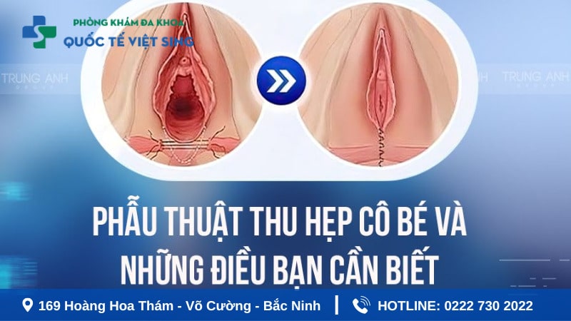 Có mẹ nào thu hẹp vùng kín chưa?
