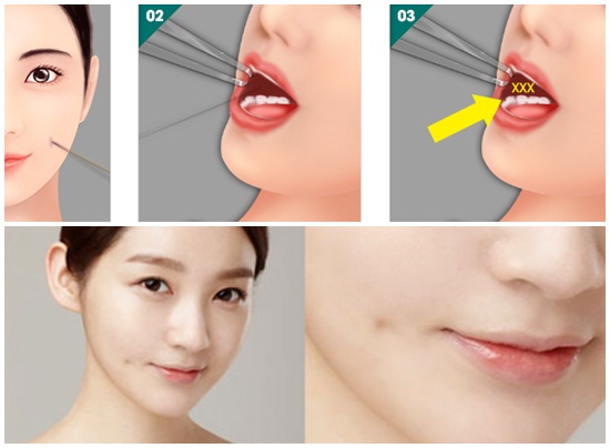 Có Nên Làm Má Lúm Đồng Tiền Không?