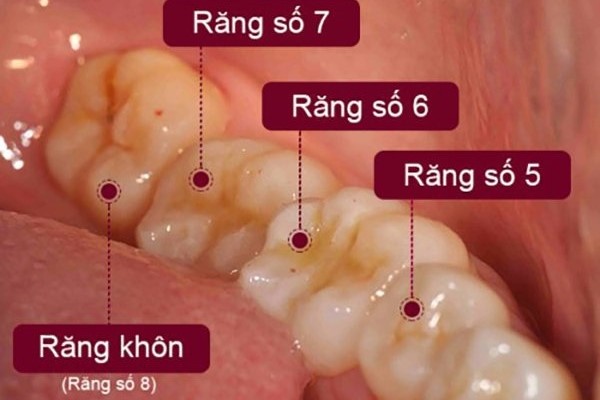 Có Nên Nhổ Răng Số 8 Hàm Dưới Không?