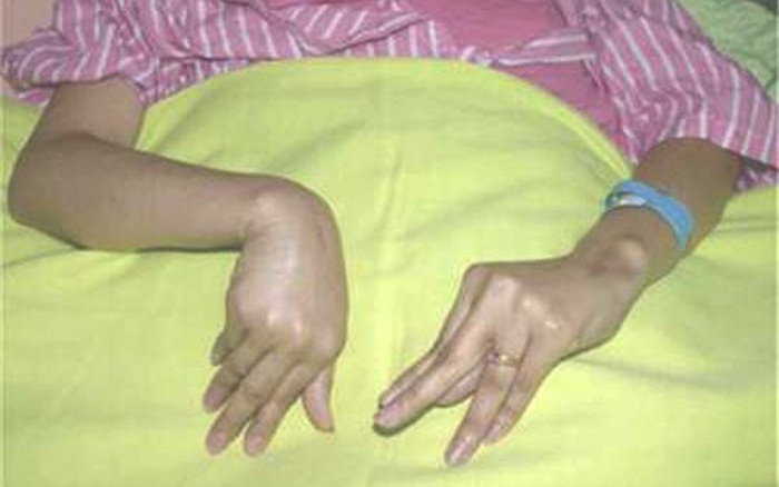 Co Quắp Tay Chân: Nguyên Nhân, Triệu Chứng Và Cách Điều Trị