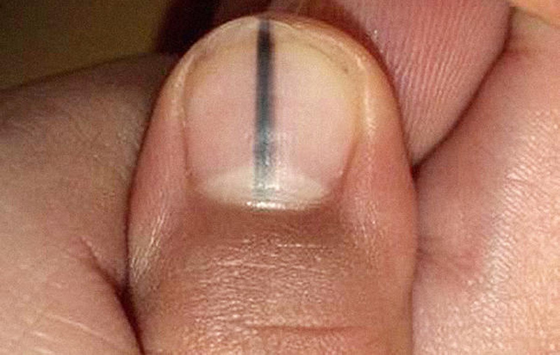 Có Sọc Đen Trên Móng Tay: Nguyên Nhân, Triệu Chứng Và Cách Điều Trị
