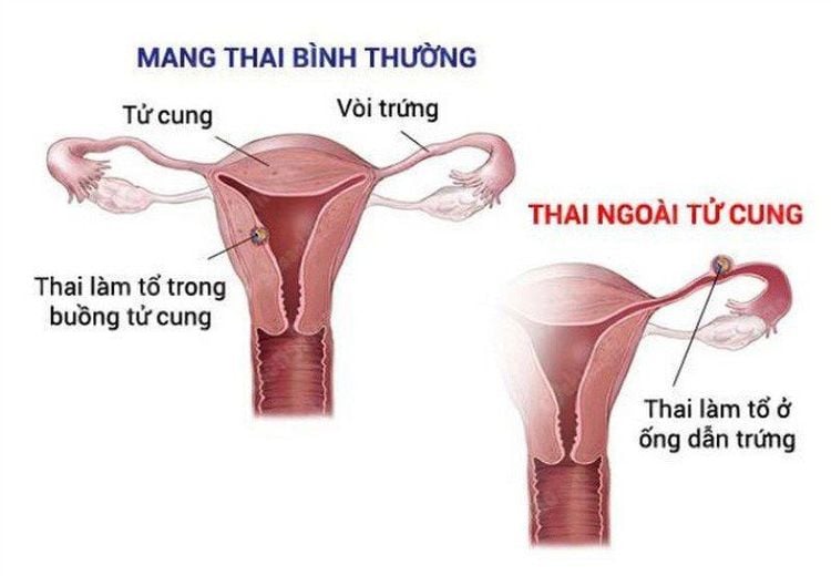 Có thai ngoài tử cung thử que có lên không?