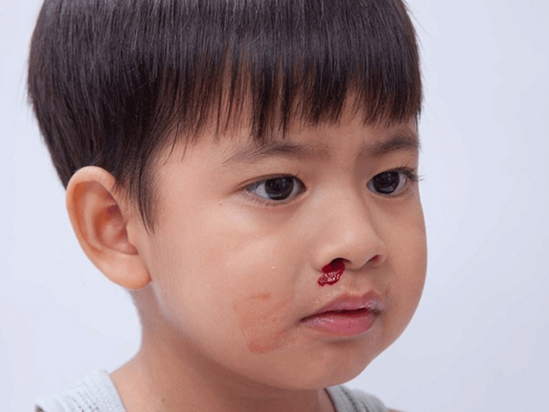 Con nít chảy máu cam: Nguyên nhân, cách xử trí và khi nào cần đến bác sĩ