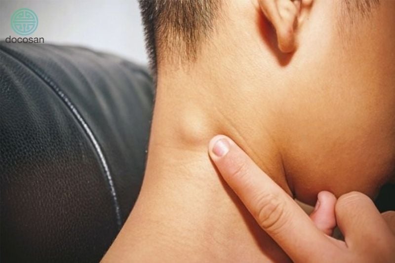 Cục U Sau Gáy: Nguyên Nhân, Triệu Chứng Và Điều Trị