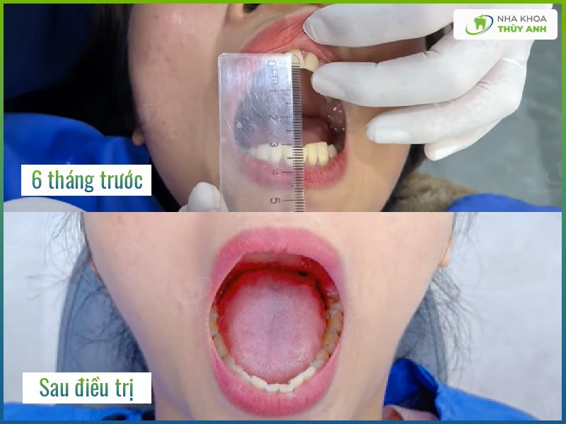 Cứng hàm không há miệng được: Nguyên nhân và cách khắc phục