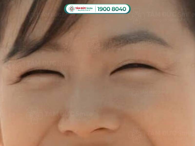 Cười Tít Mắt Là Gì? Gallery 2