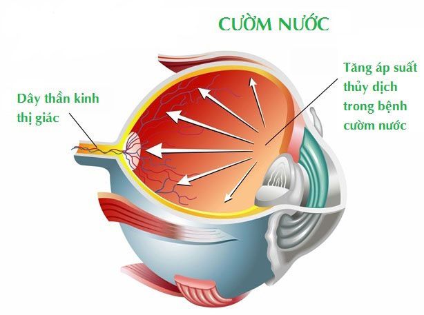 Cườm Nước Có Nguy Hiểm Không?