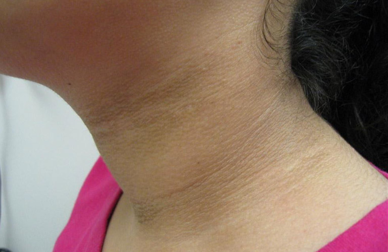 Da cổ bị sần đen: Nguyên nhân và cách khắc phục hiệu quả