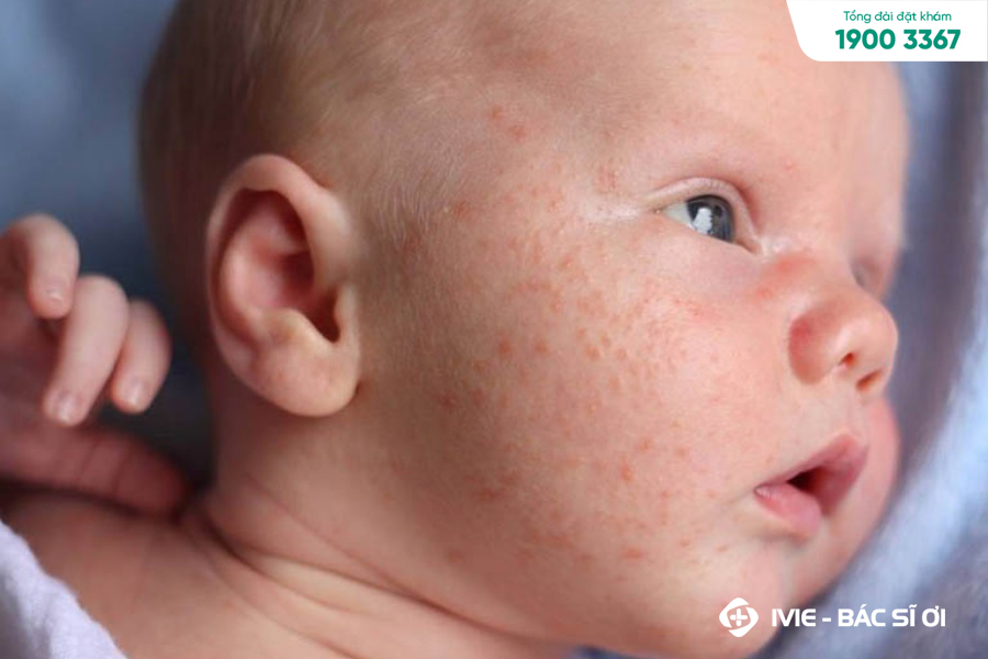 Da Mặt Bé Bị Nổi Hạt Sần Sùi: Nguyên Nhân Và Cách Khắc Phục