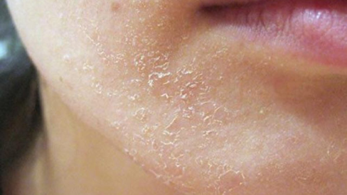 Da mặt khô tróc vảy: Nguyên nhân, cách điều trị và phòng ngừa
