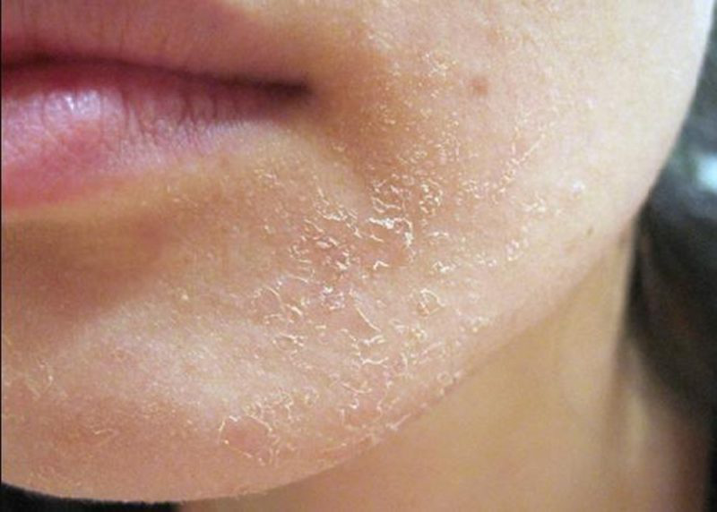 Da mặt bị sần sùi: Nguyên nhân, cách khắc phục và phòng ngừa