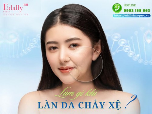 Da mặt chảy xệ ở tuổi dậy thì: Nguyên nhân và cách khắc phục