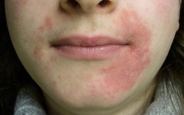 Da mặt khô, rát, đỏ vào mùa đông: Nguyên nhân và cách khắc phục