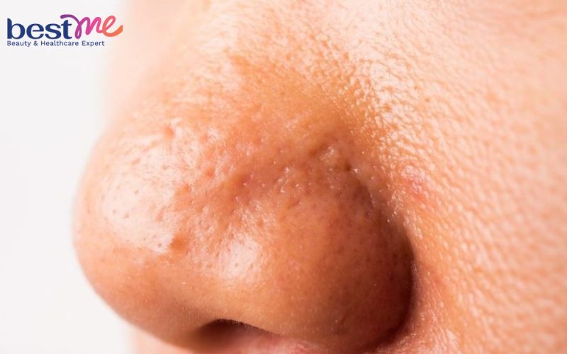 Da Mũi Sần Sùi: Nguyên Nhân và Cách Khắc Phục