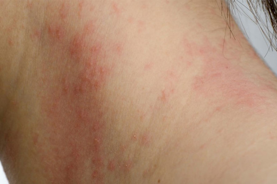Da nổi mẩn đỏ từng mảng không ngứa: Nguyên nhân và cách xử lý