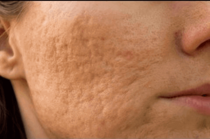 Da sần sùi vỏ cam là gì? Nguyên nhân và cách điều trị