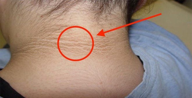 Da sau gáy bị đen: Nguyên nhân và cách khắc phục hiệu quả