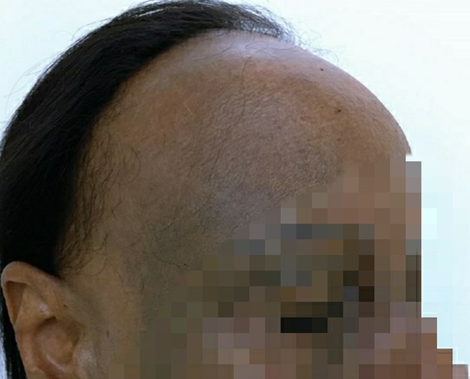 Da Trán Bị Sạm Đen: Nguyên Nhân và Cách Khắc Phục Hiệu Quả