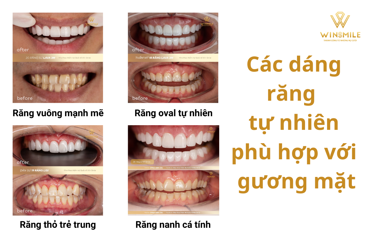 Dáng Răng Tự Nhiên Là Gì? Gallery 1