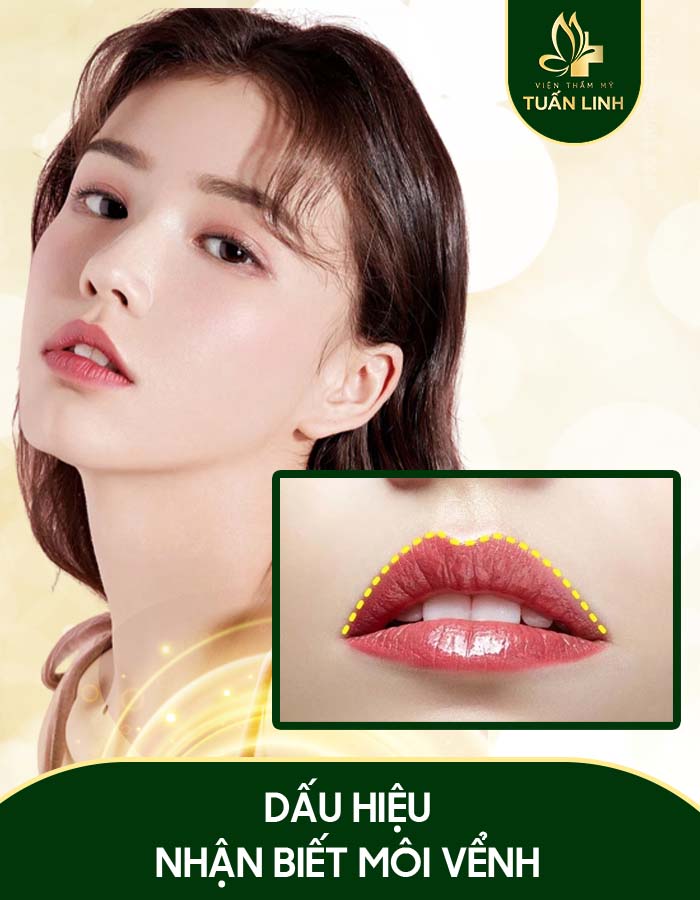 Môi Vểnh Là Gì? Gallery 1