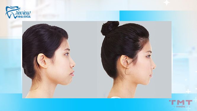 Tướng Môi Trên Nhô Ra: Ý Nghĩa, Đặc Điểm Và Phân Tích Gallery 1