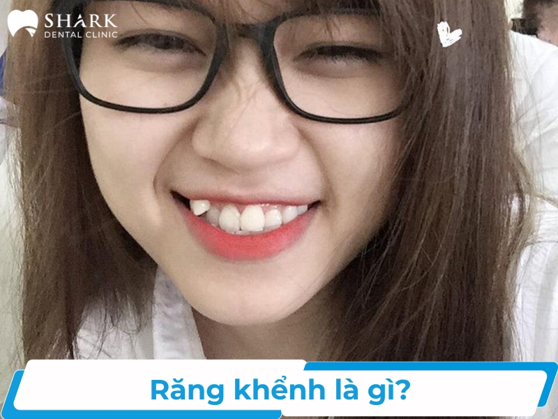 Răng khểnh là gì? Gallery 2