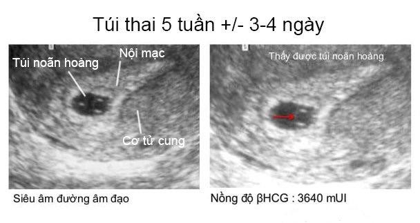 Túi Thai Bờ Đều Là Gì? Gallery 1