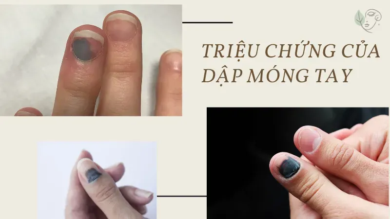 Dập ngón tay bao lâu thì lành?